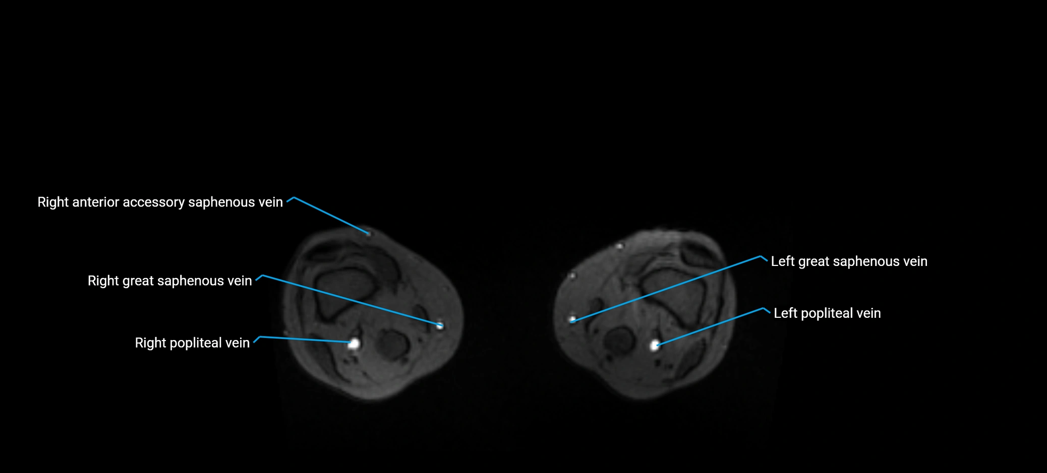 MRV abdomen pelvis & lower limb axial cross sectional anatomy labelled MRI image 351.webp